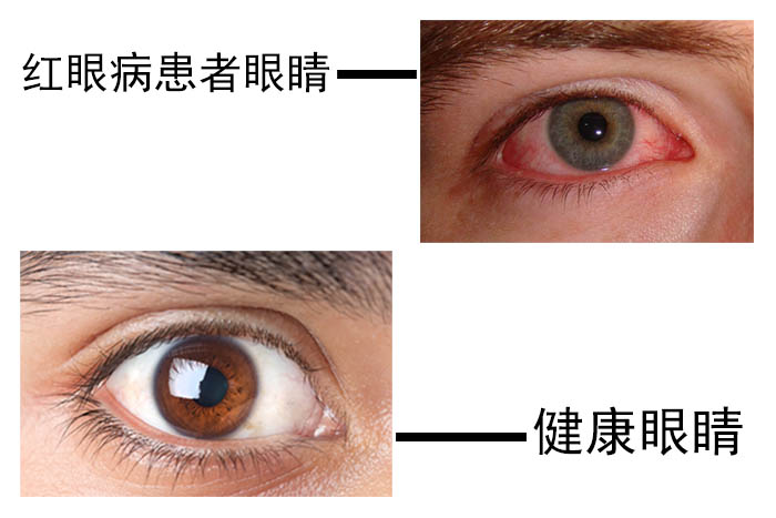 怎样预防红眼病