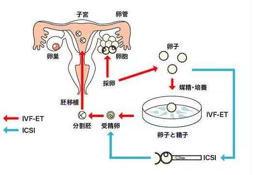 一代、二代、三代试管，究竟怎么选