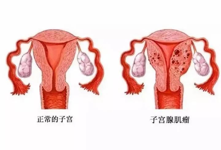 【健康科普】关于子宫肌瘤的二三事